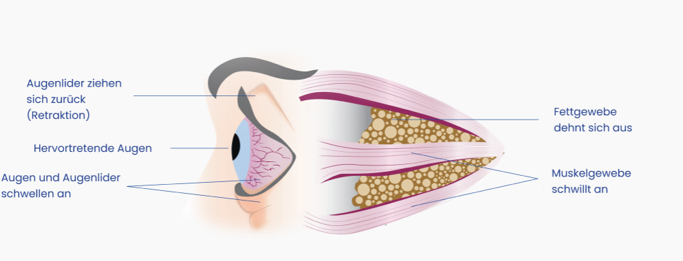 Endokrine Orbitopathie | Aktive Phase der Erkrankung